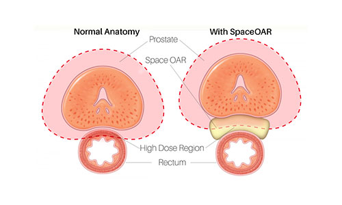 💥New ~ SpaceOAR Vue Hydrogel Spacer Procedure (for prostate CA