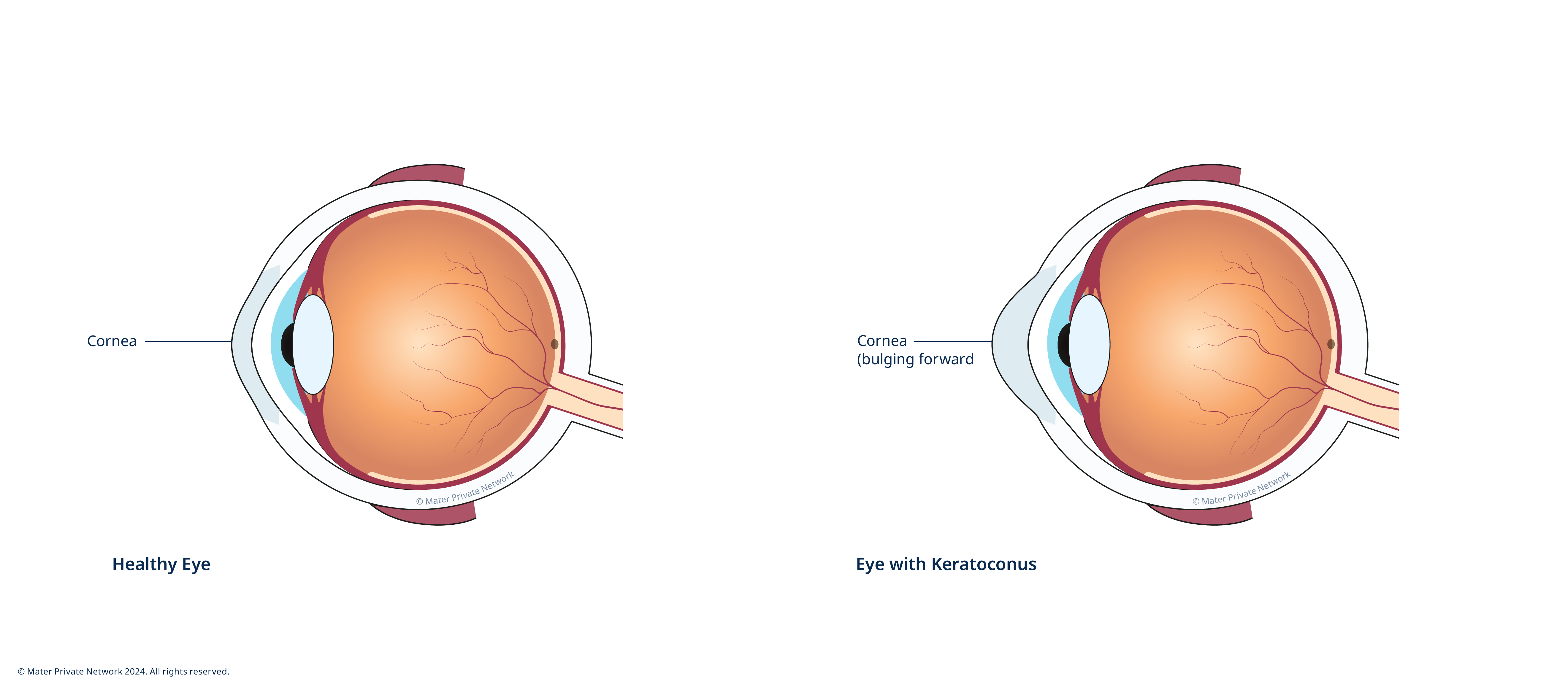 Keratoconus
