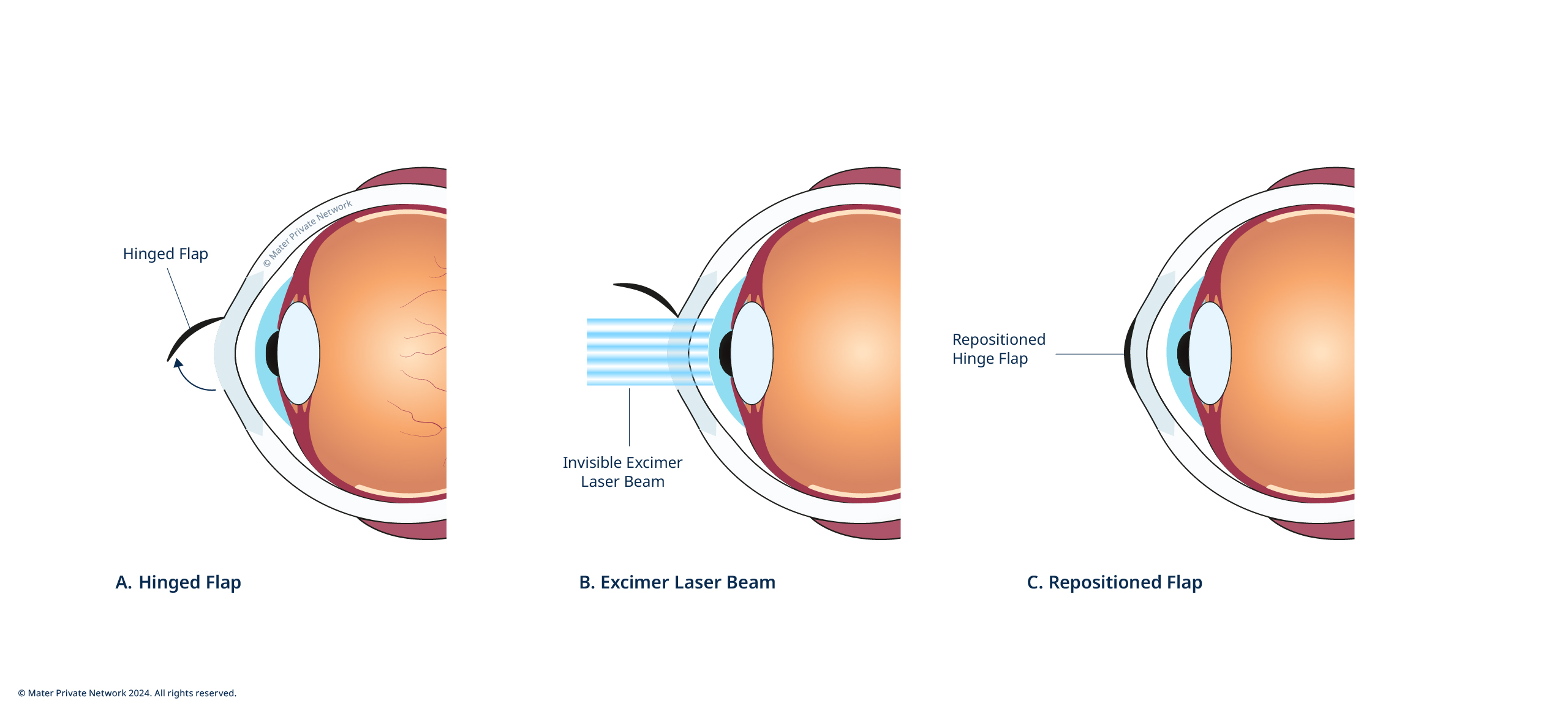 LASIK LASIK